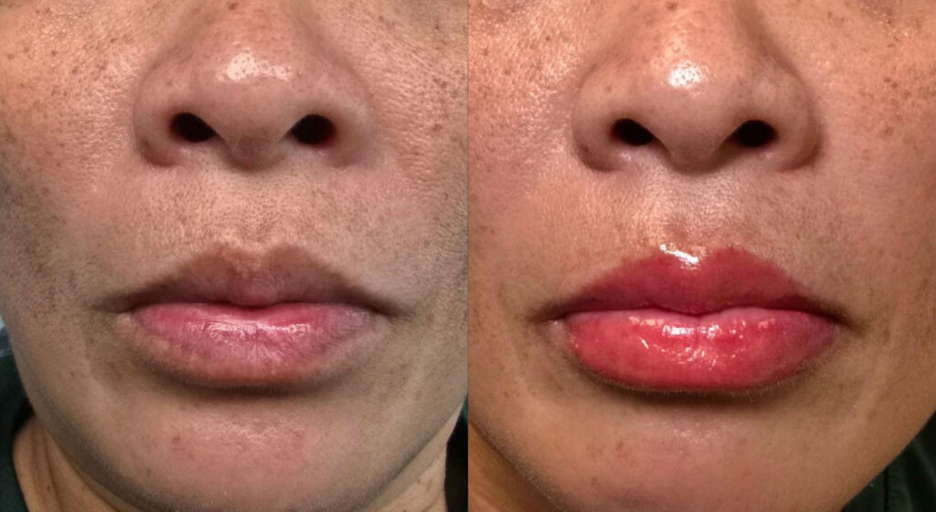 Lip Blush Tinting Before and After Photo by Forward Healthy Lifestyles in Germantown, WI