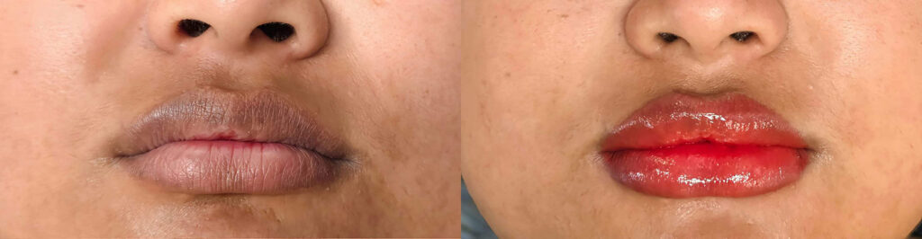 Lip Blush Tinting Before and After Photo by Forward Healthy Lifestyles in Germantown, WI